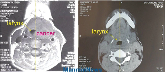 Laryngeal cancer scan before prayer showing displaced larynx and after prayer showing remarkable improvement